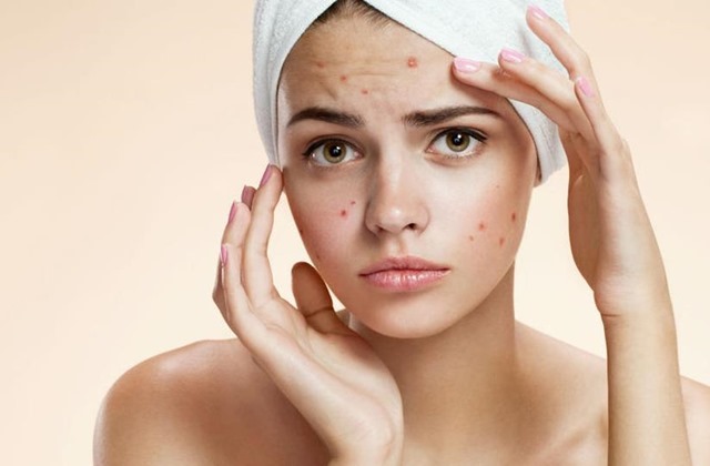 L’ acne : come trattare i casi più difficili