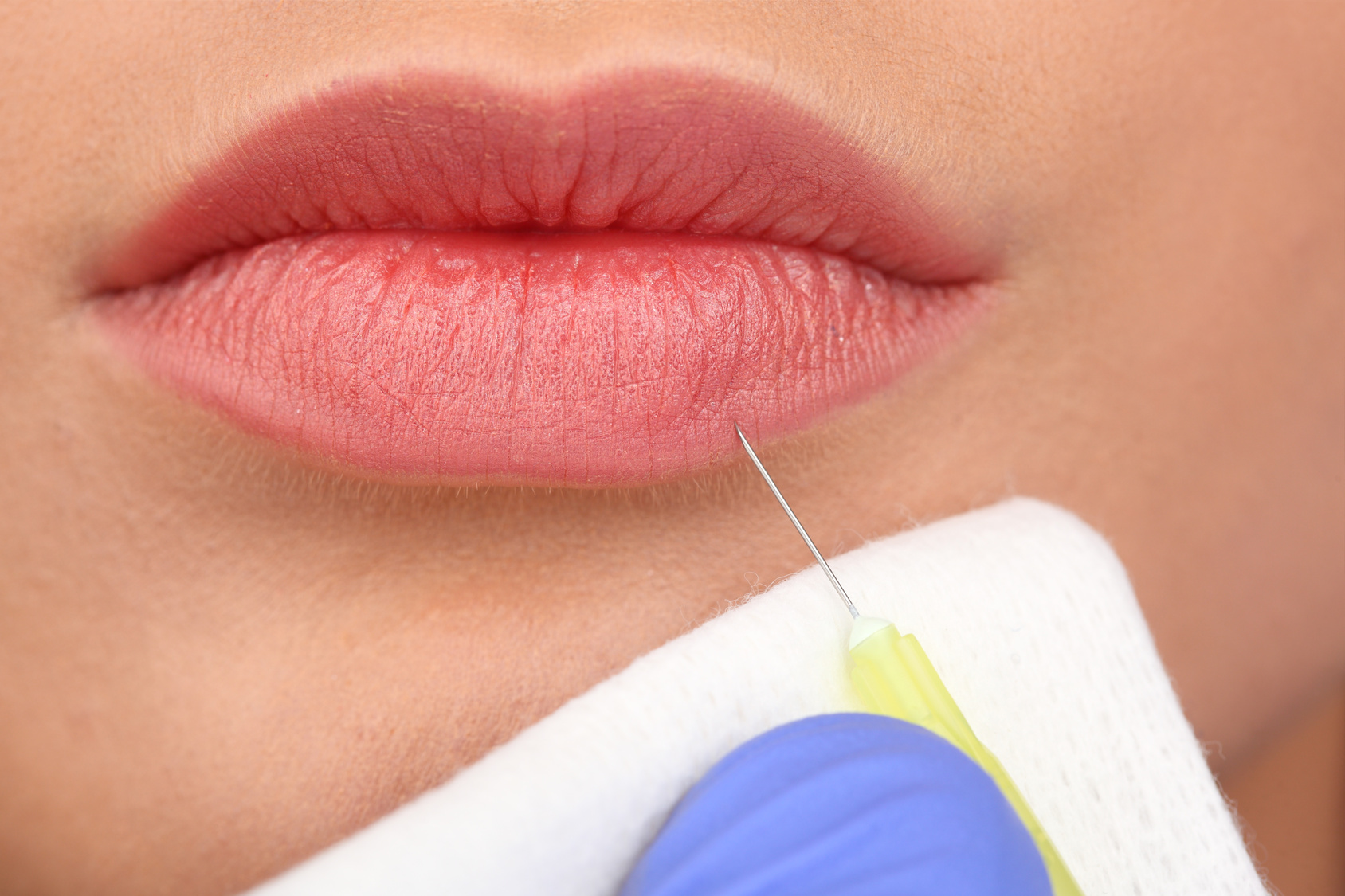 Rimodellare le labbra con  il “Kissing Lip Design”