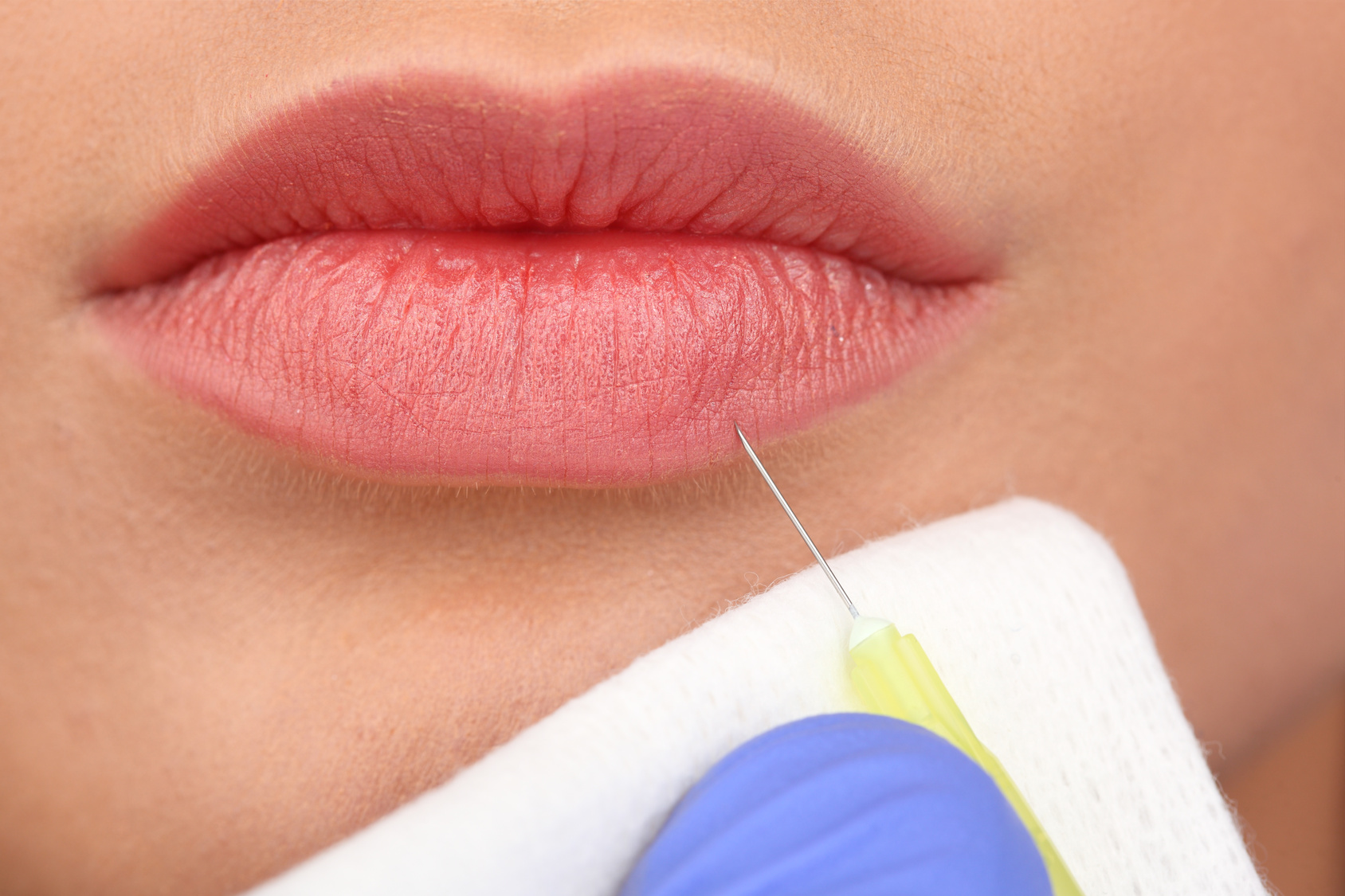 Come avere belle labbra rimodellate con i filler - TuaMe.it