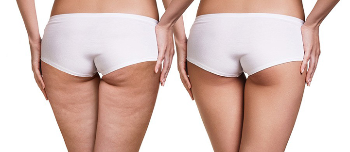 Addio Cellulite in una sola seduta