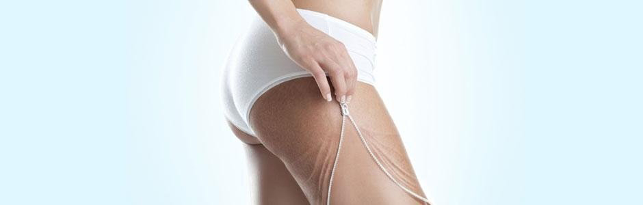 Lotta alla cellulite, possiamo vincere!