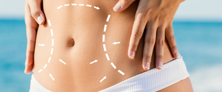 Body contouring: il trattamento per rimodellare il corpo, anche senza chirurgia