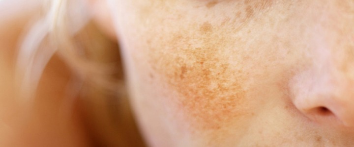 Melasma - Cloasma, cause e cure