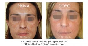 trattamento delle macchie iperpigmentate con zo skin health e 3 step stimulation peel