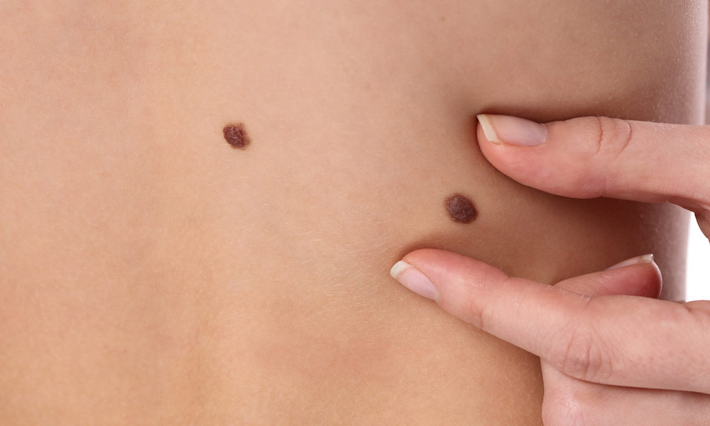 Melanoma: cause, sintomi, diagnosi