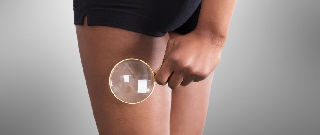 Mesoterapia: in cosa consiste nel trattamento della cellulite