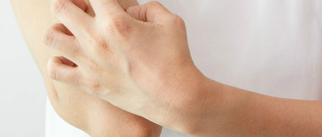 Eczema: cause e cura