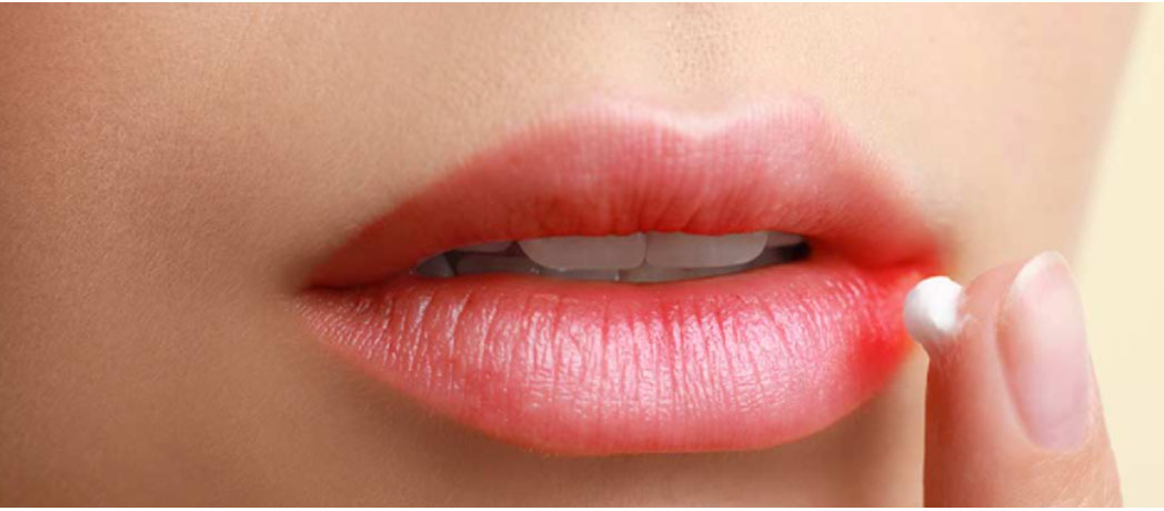 Cheilite (infiammazione labbra) sintomi e cura