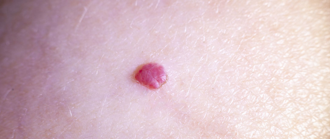 Angioma