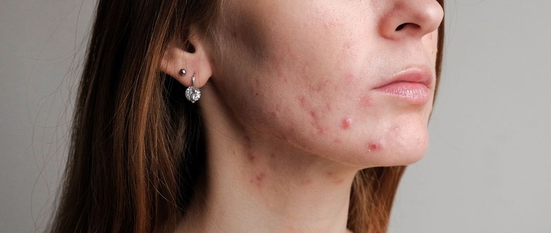 Acne e rosacea: i consigli dello specialista