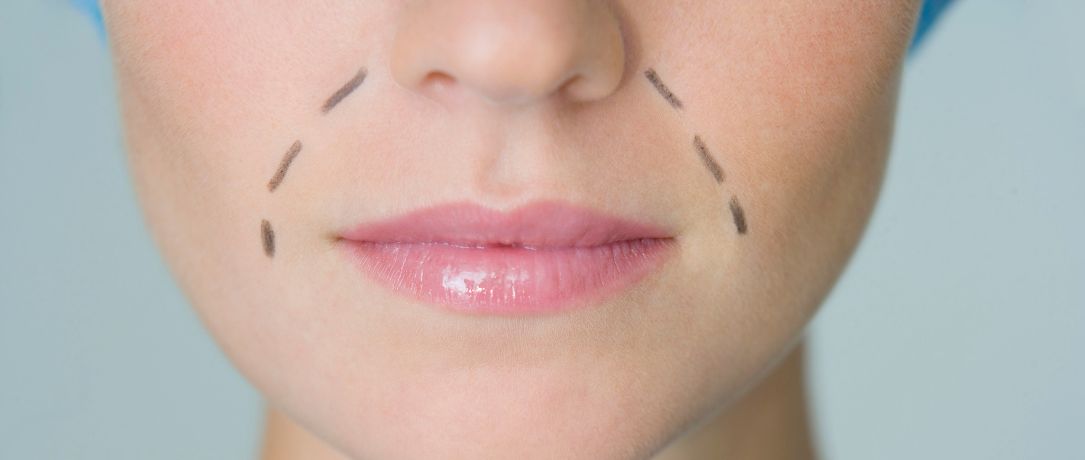 Rughe naso labiali: come eliminarle?