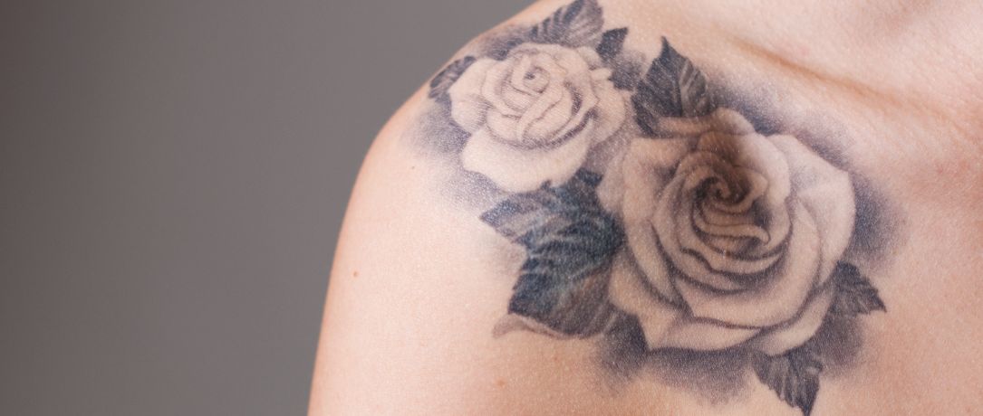 Rimuovere il tatuaggio in medicina estetica: opzioni, risultati e cosa aspettarsi