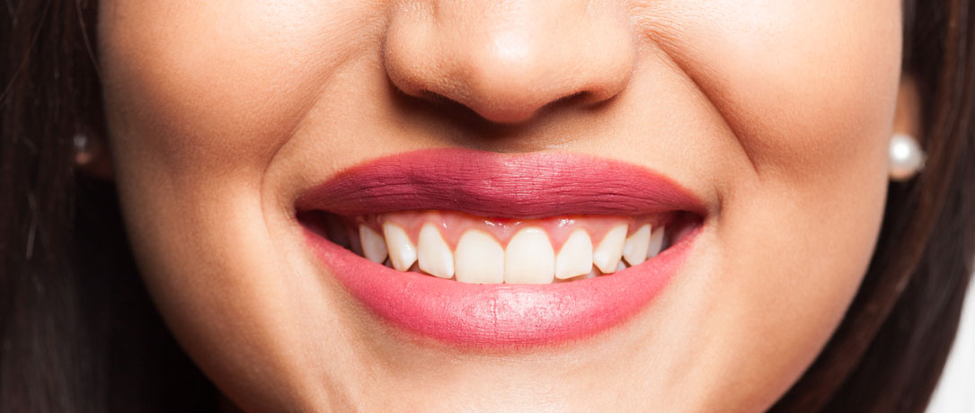 Sorriso gengivale: come risolvere il problema con il filler