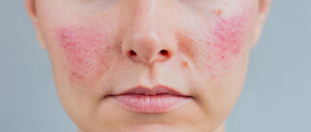 Couperose: livelli, cause, sintomi e trattamenti