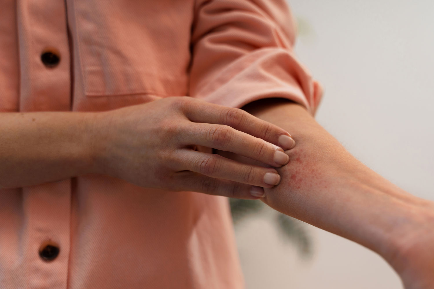 Dermatite da processionaria