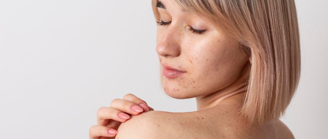 Pelle grassa, pori dilatati e impurità: il ruolo del peeling bifasico al TCA