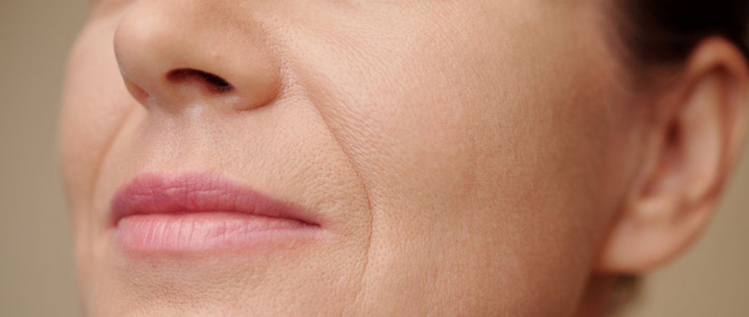 Solchi nasogenieni: quando usare il filler