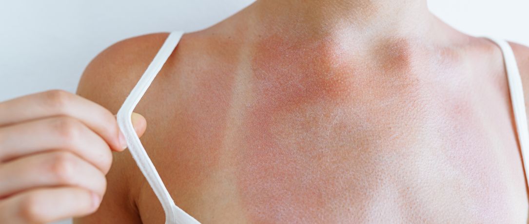 Rimedi per scottature solari: trattamenti medici ed estetici